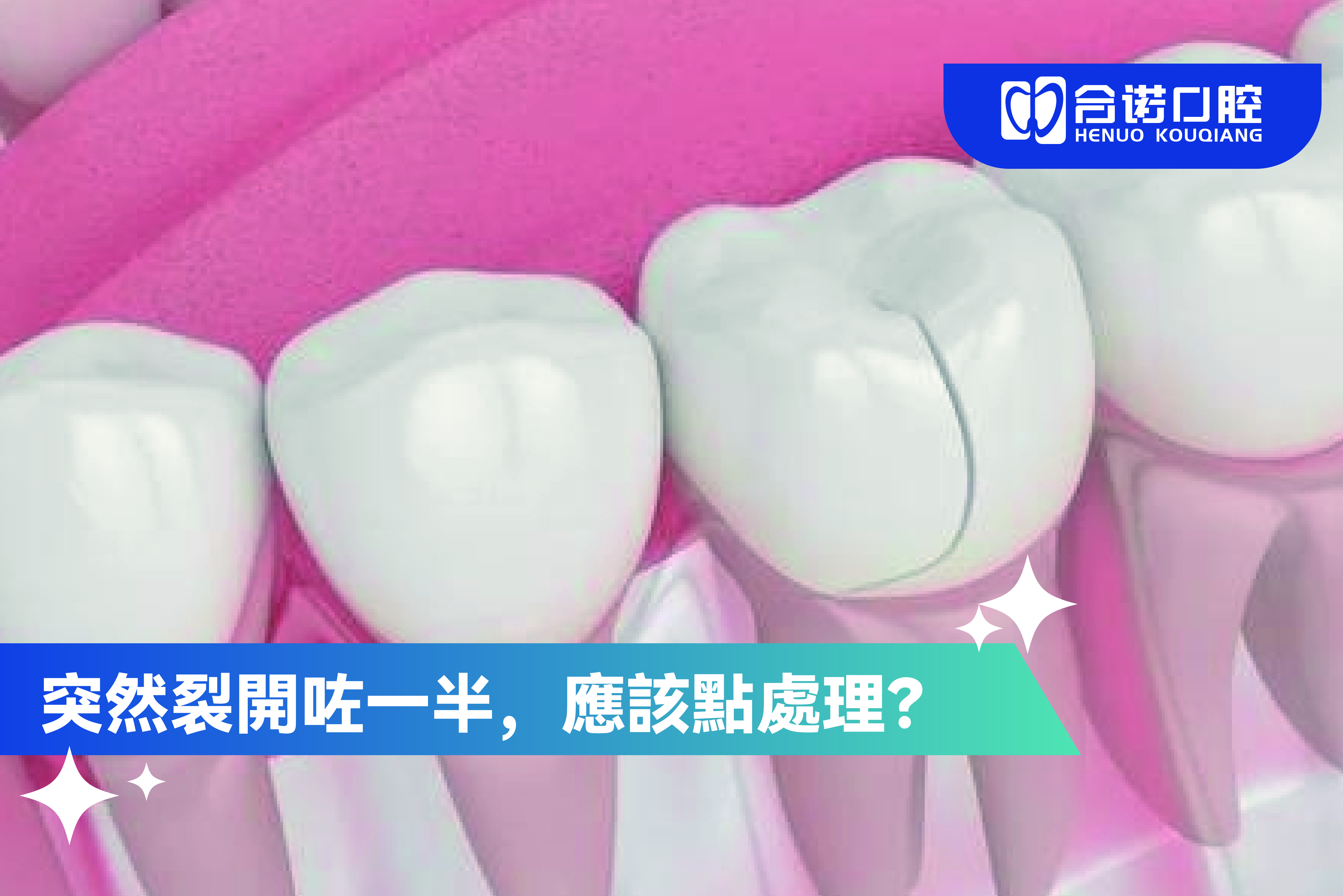 最入面隻大牙，突然裂開咗一半，應該點處理？